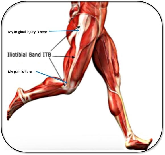 Iliotibial Band Friction Syndrome: The Physio Approach