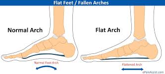 flat foot