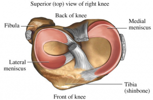 meniscus tear