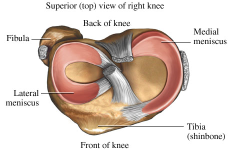 meniscus tear