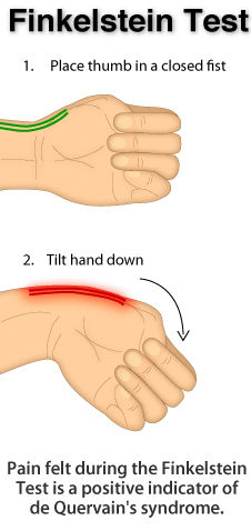 Finkelstein test - Pain in my Wrist