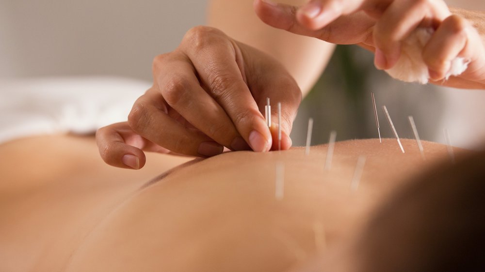 What are the benefits of dry needling? | MGS Physiotherapy