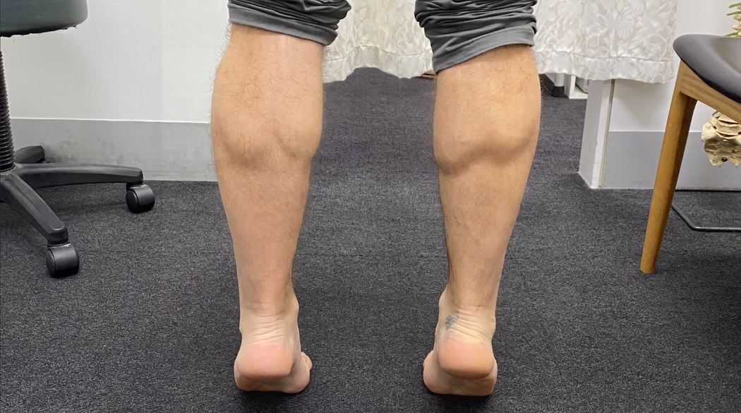 https://www.mgs.physio/app/uploads/2022/10/Calf-Tear-Rehab-2.jpg