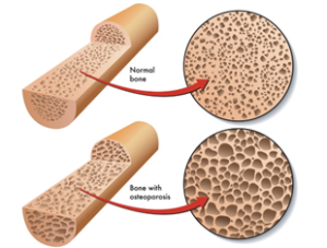 Osteoporosis and Exercise