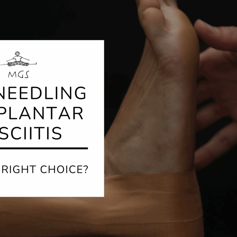 Is Dry Needling the Right Choice for Your Plantar Fasciitis?