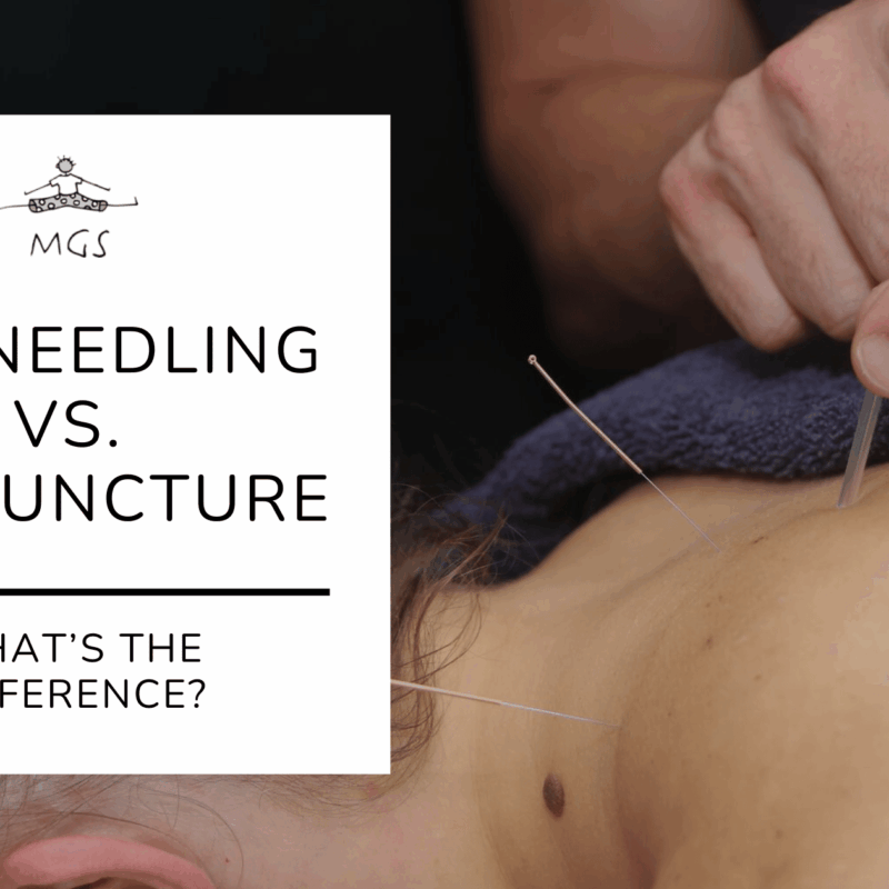 Dry Needling vs. Acupuncture What’s the Difference